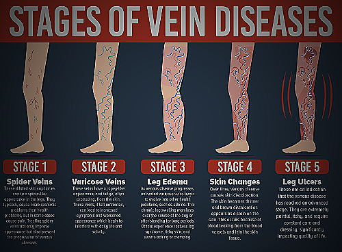 Anatomical diagram of varicose veins in leg - do men get varicose veins