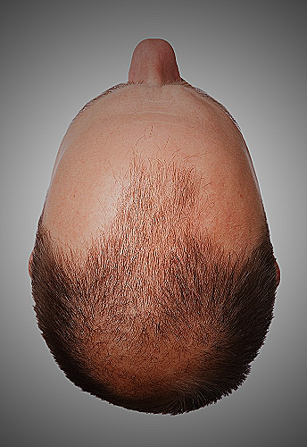 Hair Loss Prevention - why do men go bald and women don t