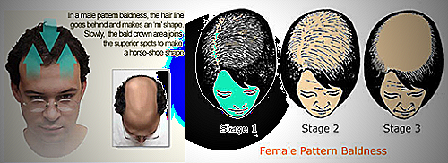 Male Hair Loss Vs Female Hair Loss